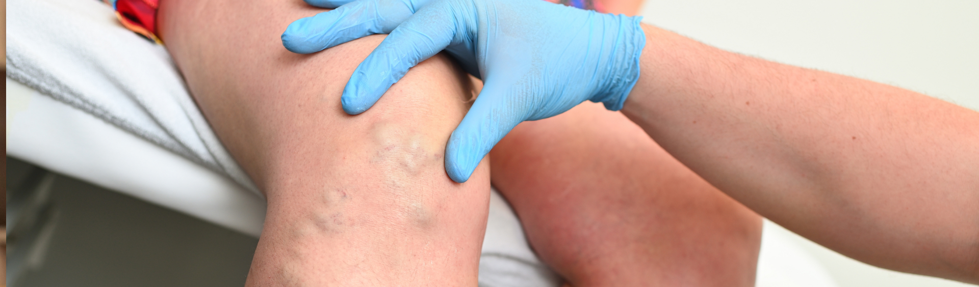 Varizes em homens: conheça os sintomas e tratamentos