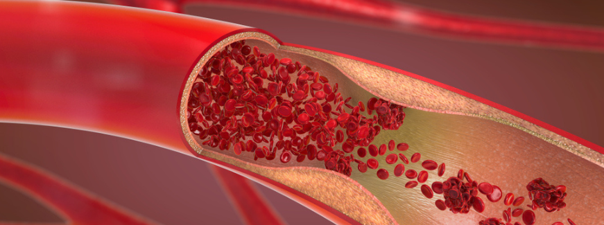 Disfunção endotelial