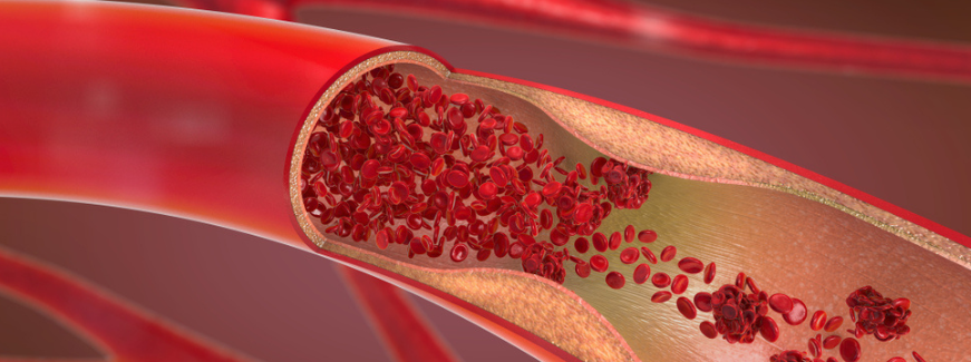 Disfunção endotelial: o que é, causas, diagnóstico e tratamento