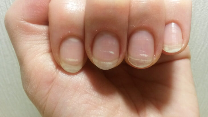 Síndrome das unhas frágeis