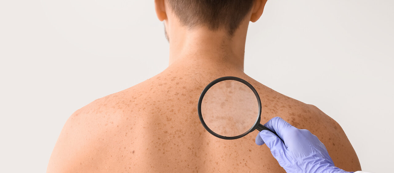Linfoma cutâneo