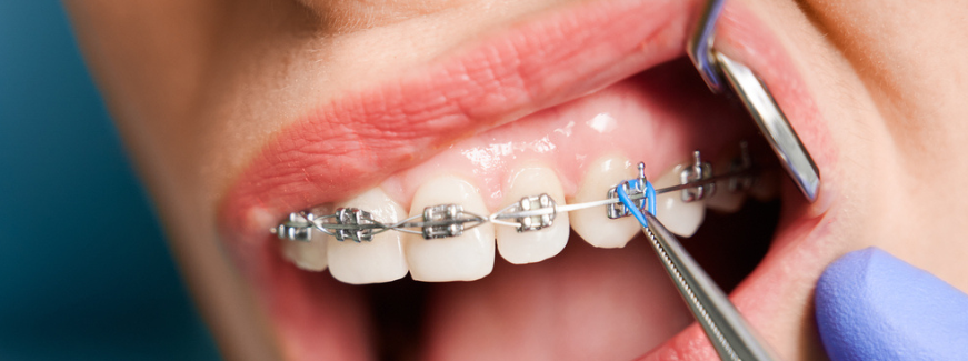 aparelho ortodôntico