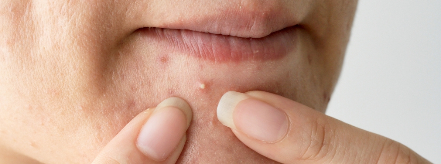 Espremer espinha: conheça os malefícios da prática para a pele