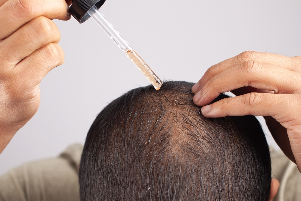 Minoxidil: Anvisa contraindica medicamento para queda de cabelo