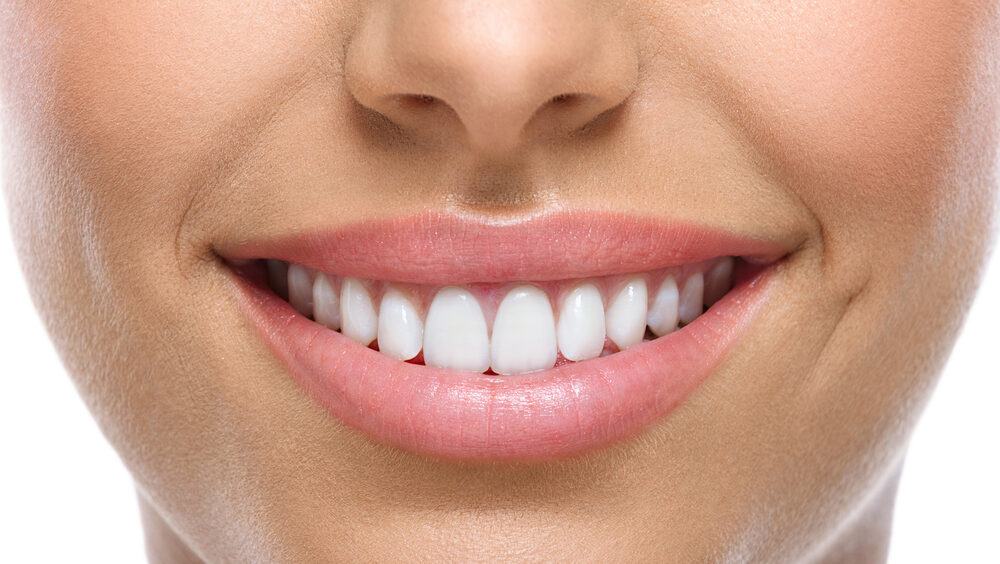 facetas dentárias