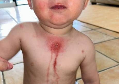 Fitofotodermatite: mãe alerta sobre queimadura do filho com limão