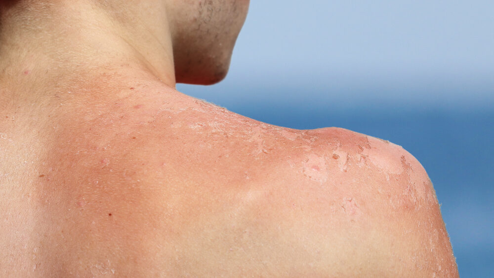 por que a pele descama depois de tomar sol