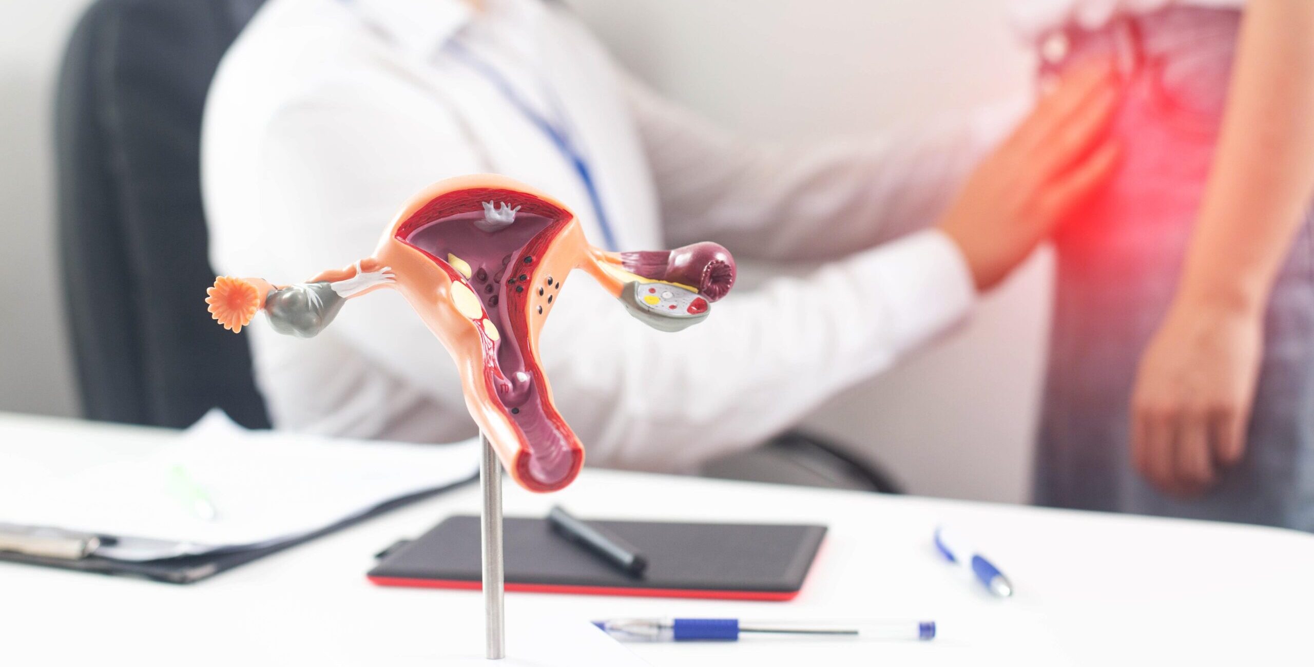 Fibroma uterino: tudo sobre os nódulos benignos