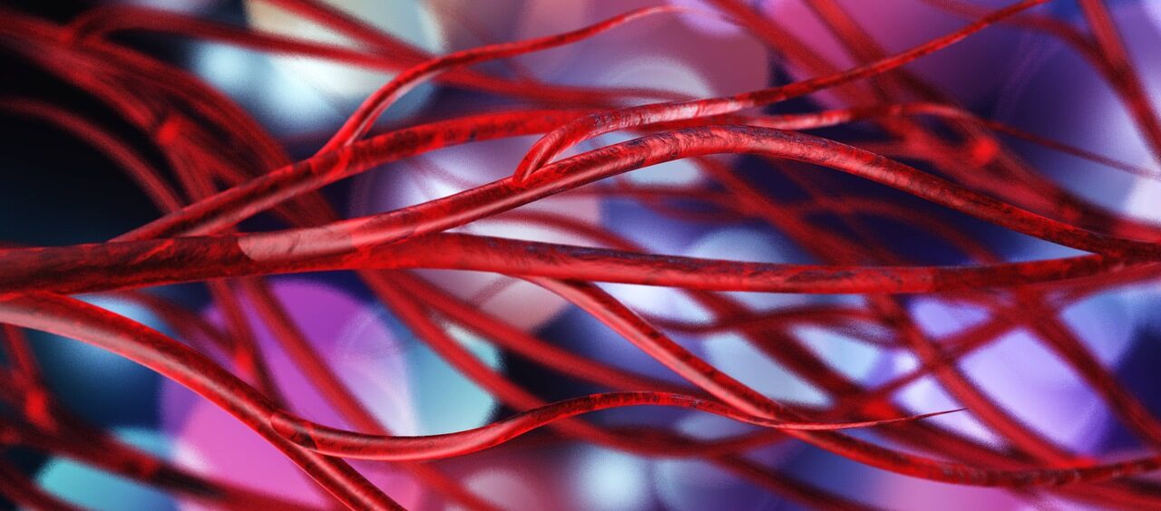 Malformação arteriovenosa