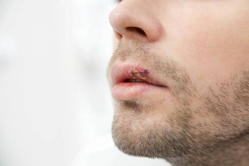 Câncer de lábios: o que é, causas e formas de se prevenir
