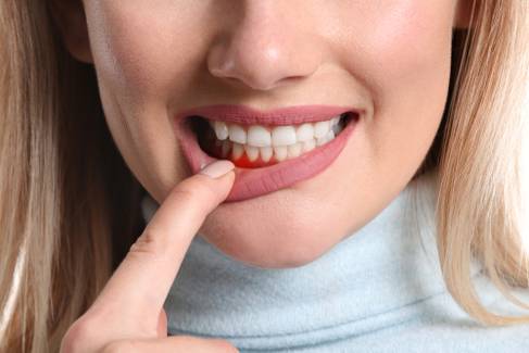 Gengivite e periodontite: Pesquisadores da USP criam pastilha que ajuda no tratamento