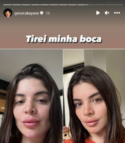 gkay preenchimento labial