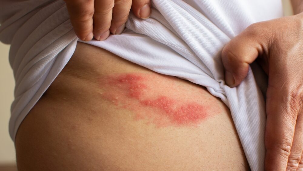 riscos do herpes zoster
