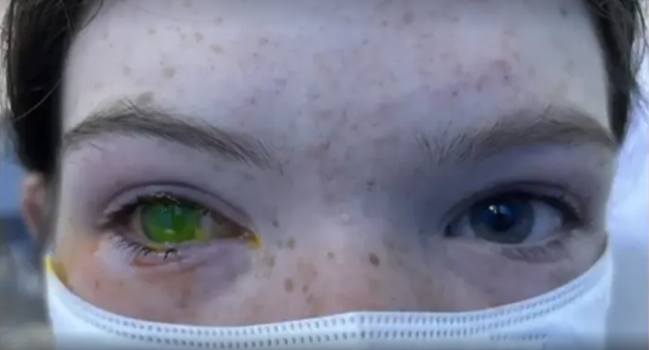 Olho de Natal: doença faz os olhos ficarem esverdeados