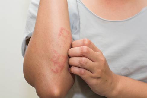 Dupilumabe para dermatite atópica terá cobertura pelos convênios