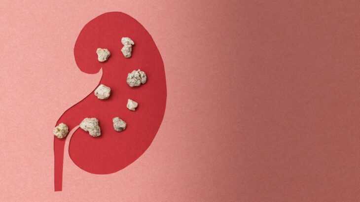 mitos sobre pedras nos rins