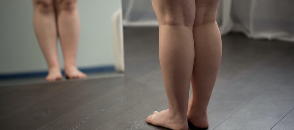 sinais do lipedema