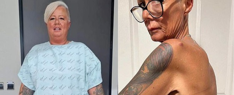 Emagrecer demais com bariátrica é comum? Caso de mulher impressiona