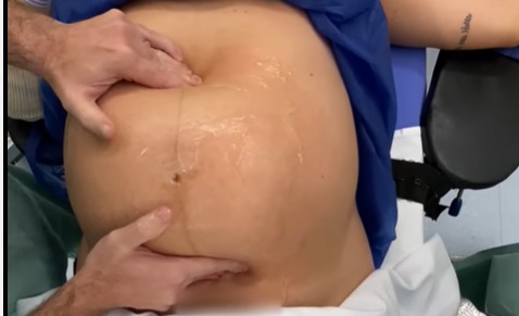 Manobra de parto viraliza nas redes sociais; prática é segura?