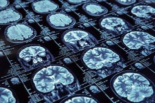 Novo exame diagnostica doença de Alzheimer em até 20 minutos