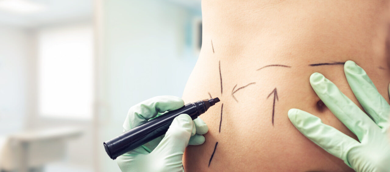 Cuidados necessários após a cirurgia bariátrica