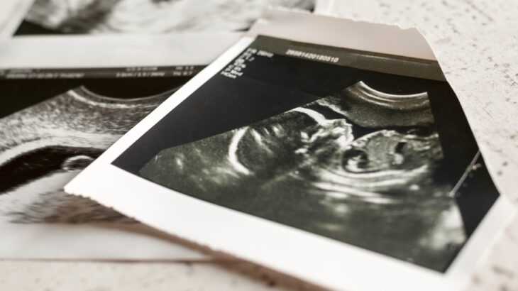 fotos de um ultrassom morfológico mostrando o rosto de um bebê