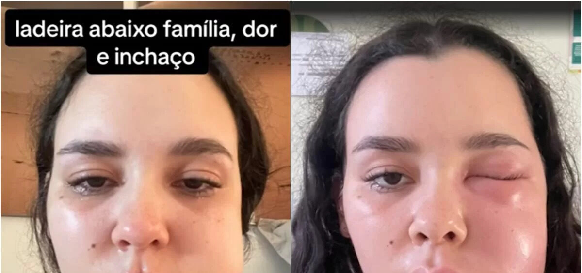 Infecção após retirar siso