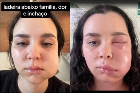 Infecção após retirar siso: jovem viraliza ao mostrar ‘traqueia deslocada’