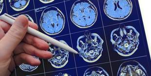 Donanemab: novo medicamento reduz avanço do Alzheimer