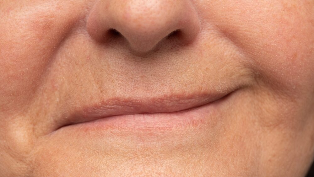 paralisia facial