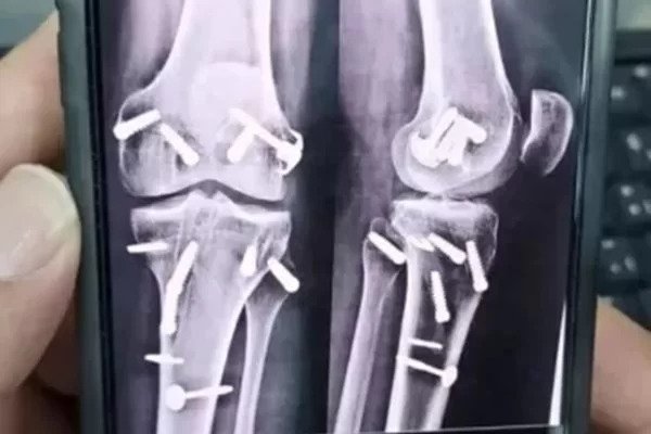 imagem de um raio-x de um joelho com pinos colocados