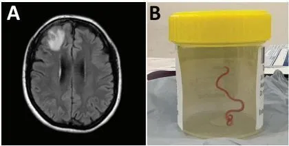 foto dividida em duas partes. De um lado, uma imagem do exame de ressonância do cérebro da paciente. Do outro, a foto de um pote com o verme retirado após a biópsia