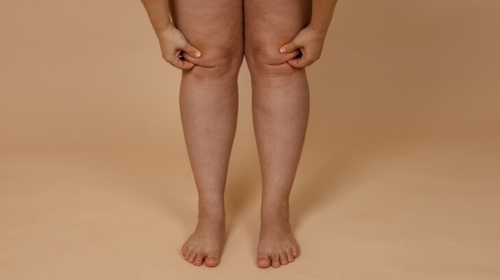 Como diferenciar o lipedema