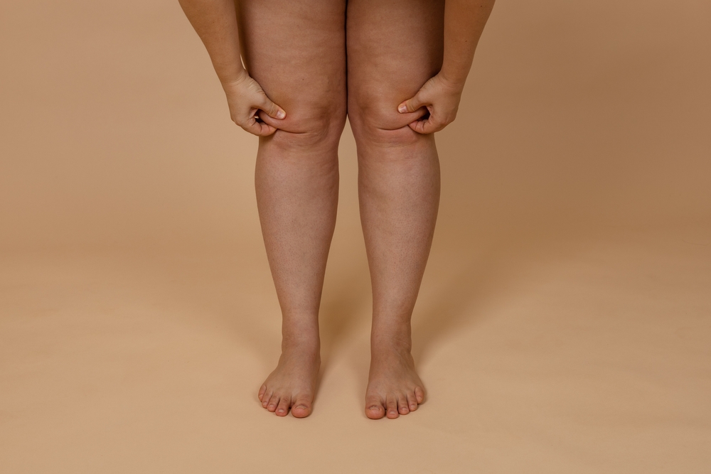É ou não é lipedema? 3 problemas comumente confundidos com a condição e saiba como diferenciar