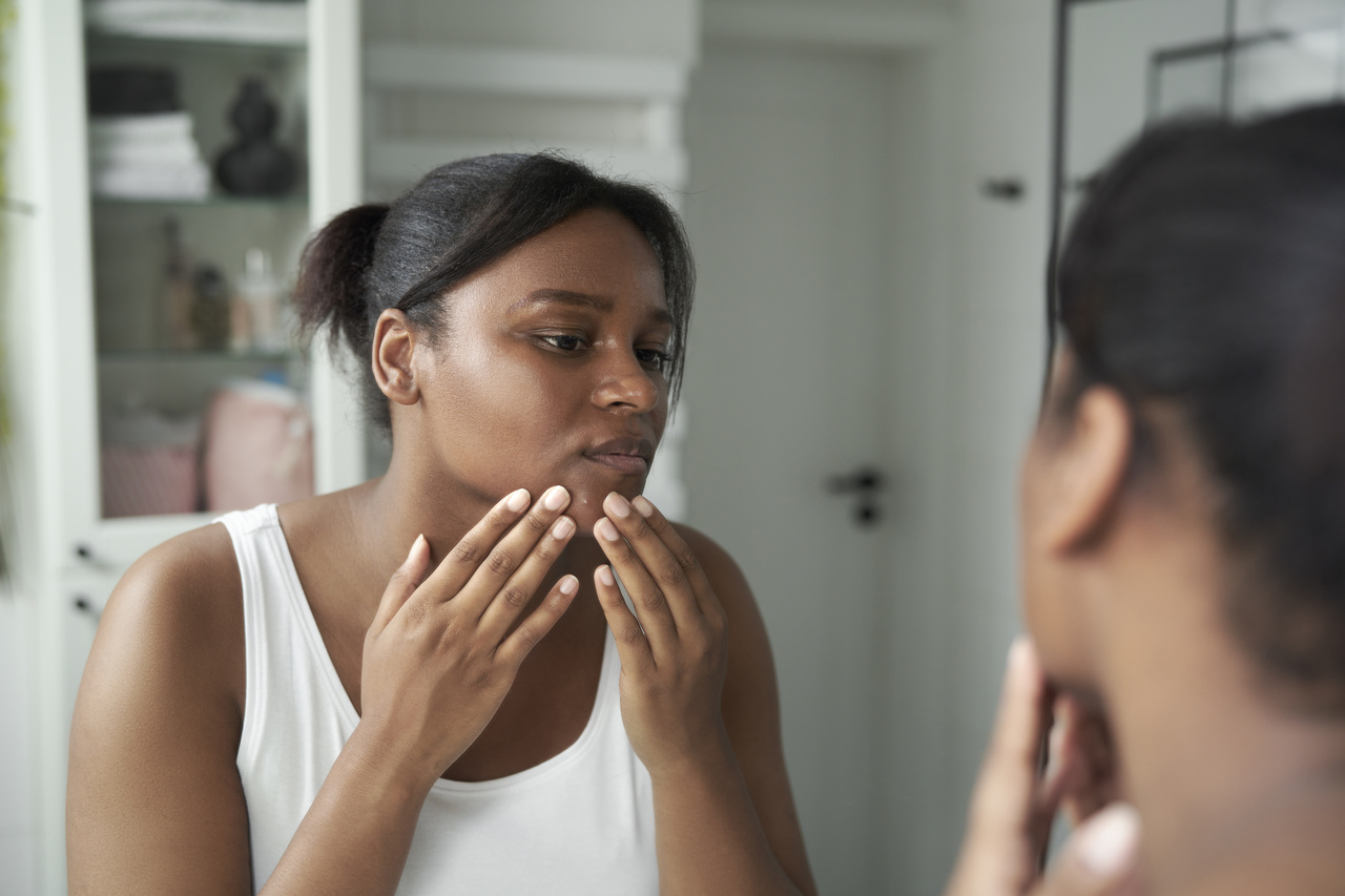 Acne solar: por que as espinhas aumentam no calor?