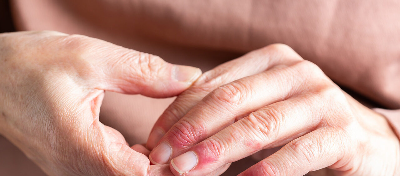mãos de uma pessoa com dermatite atópica