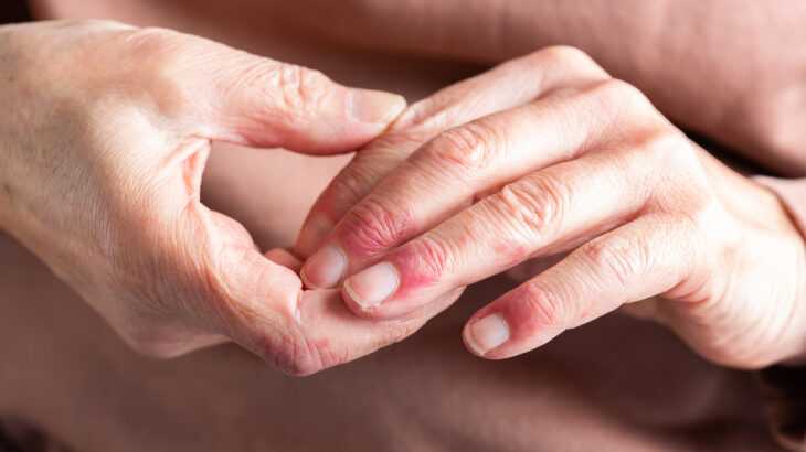 mãos de uma pessoa com dermatite atópica