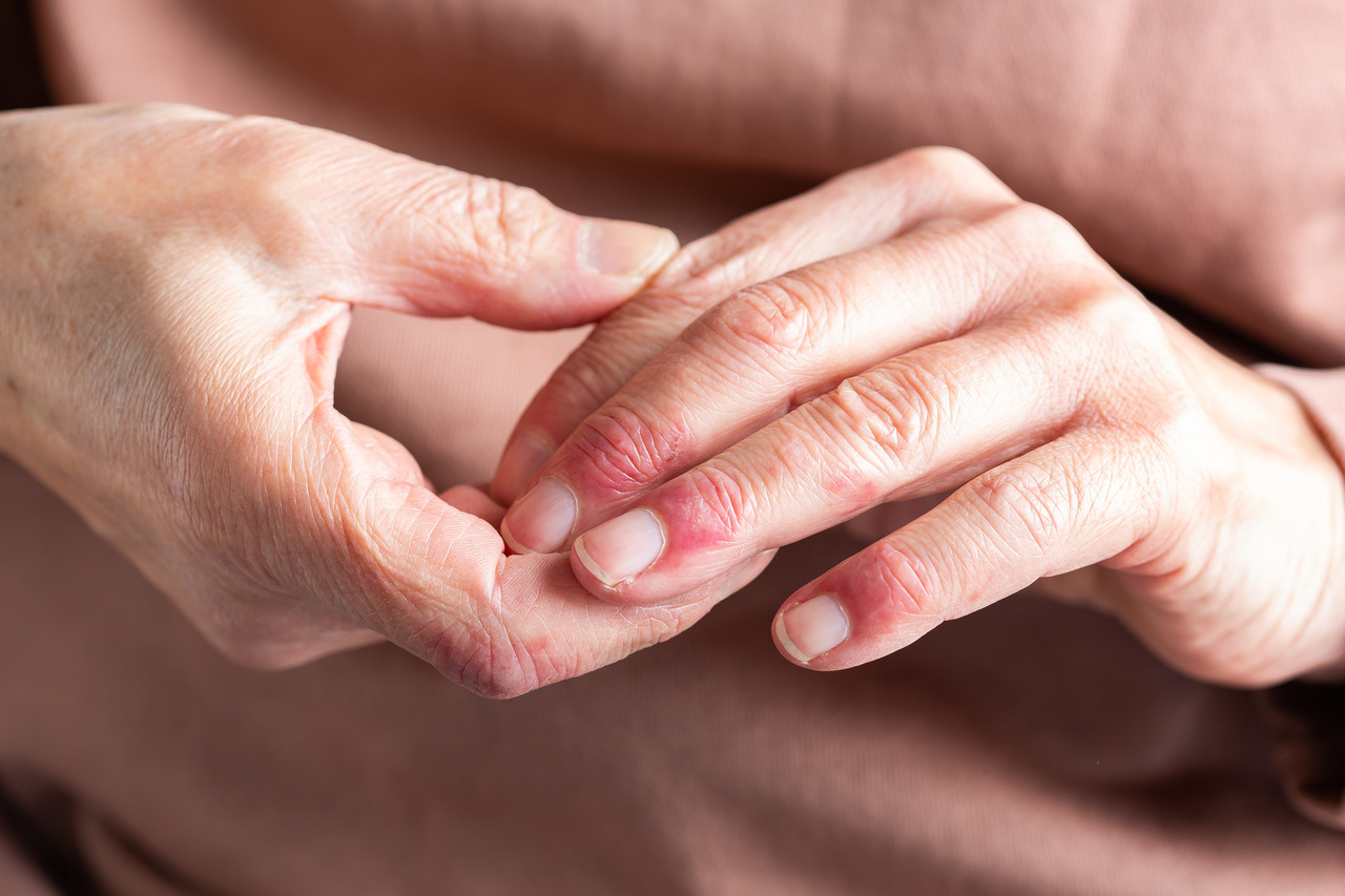 Dermatite atópica e intestino: conheça as relações