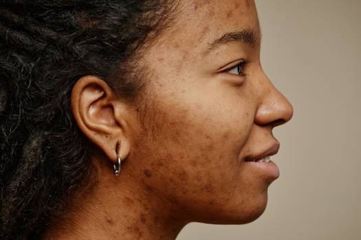 Pessoas com acne enfrentam preconceitos que prejudicam vida social e profissional, mostra estudo