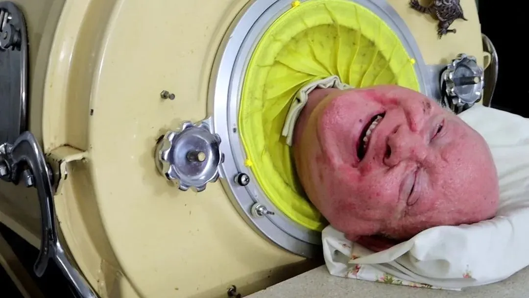 Pulmão de ferro: entenda a estrutura que ajudou homem a viver por 70 anos