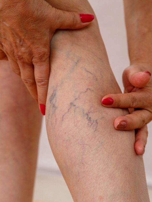 Como diferenciar veias saltadas e varizes?